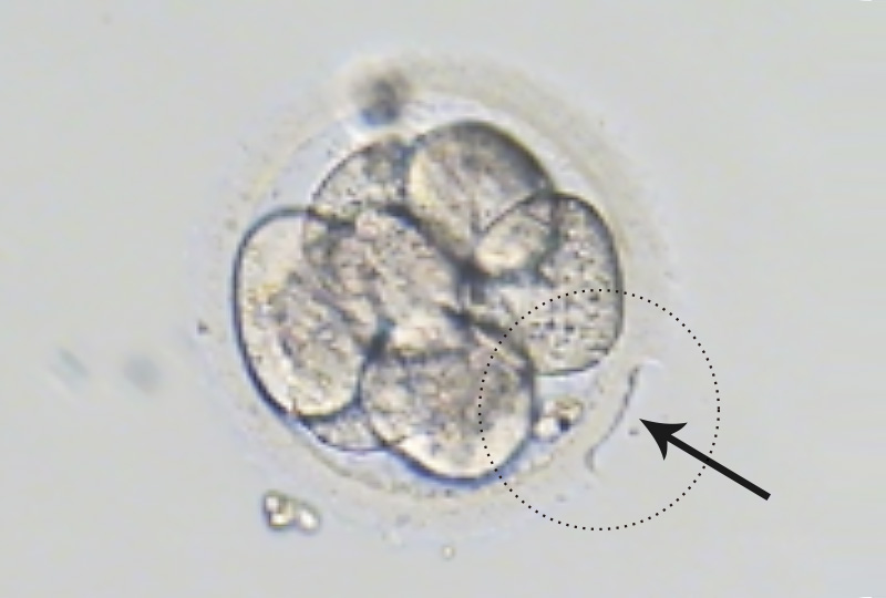  鐳射胚胎孵育術